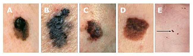 ABCDE melanomu