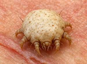 Svrab - príznaky, prenos, liečba a prevencia