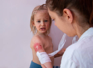 Popáleniny a ich liečba